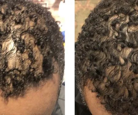 Natalya Urovish MD PC -- PRP, Fillers, Botox