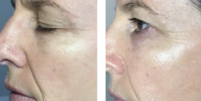 Natalya Urovish MD PC -- PRP, Fillers, Botox Picture 5