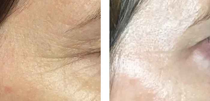 Natalya Urovish MD PC -- PRP, Fillers, Botox Picture 4