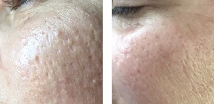 Natalya Urovish MD PC -- PRP, Fillers, Botox Picture 8