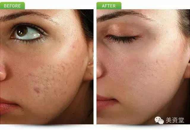 La Peau 美資堂- Thermage 熱瑪吉 M22光子嫩膚 紋眉紋綉野生眉 水光針脸部提升法令纹微针微整形 Picture 8