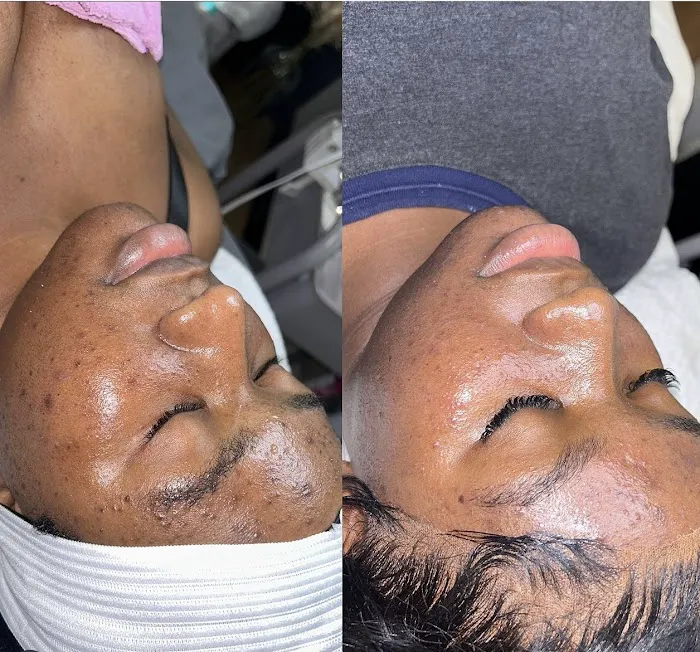 Q’kare beauty - Acne Specialist Auburn Massachusetts Picture 1