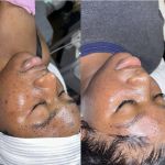 Q’kare beauty - Acne Specialist Auburn Massachusetts