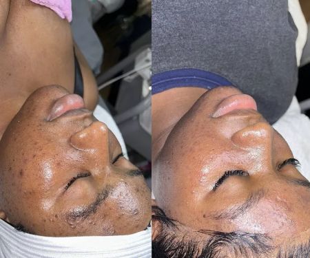 Q’kare beauty - Acne Specialist Auburn Massachusetts