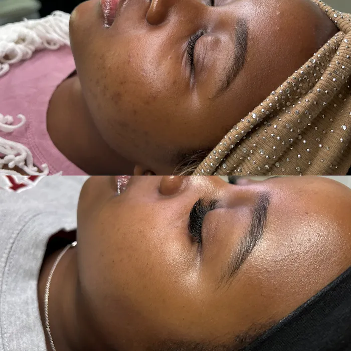 Q’kare beauty - Acne Specialist Auburn Massachusetts Picture 7