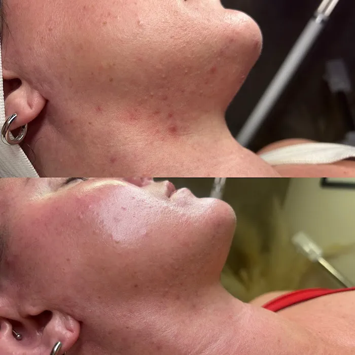 Q’kare beauty - Acne Specialist Auburn Massachusetts Picture 8