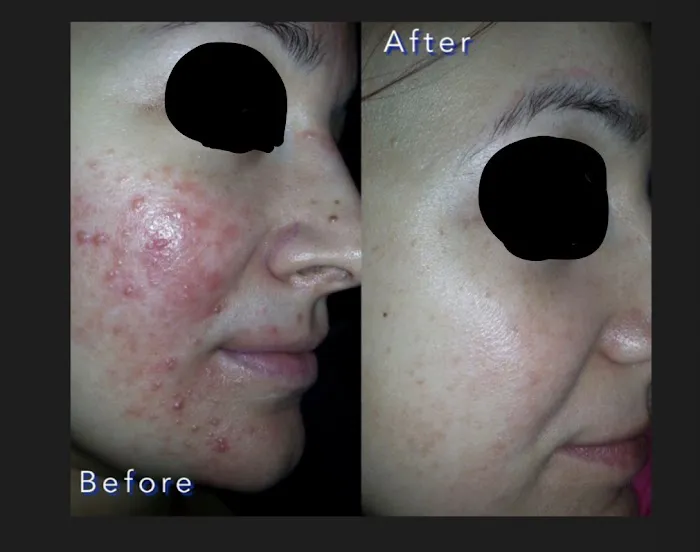 Acne center Picture 2