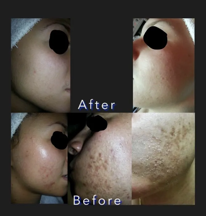 Acne center Picture 1