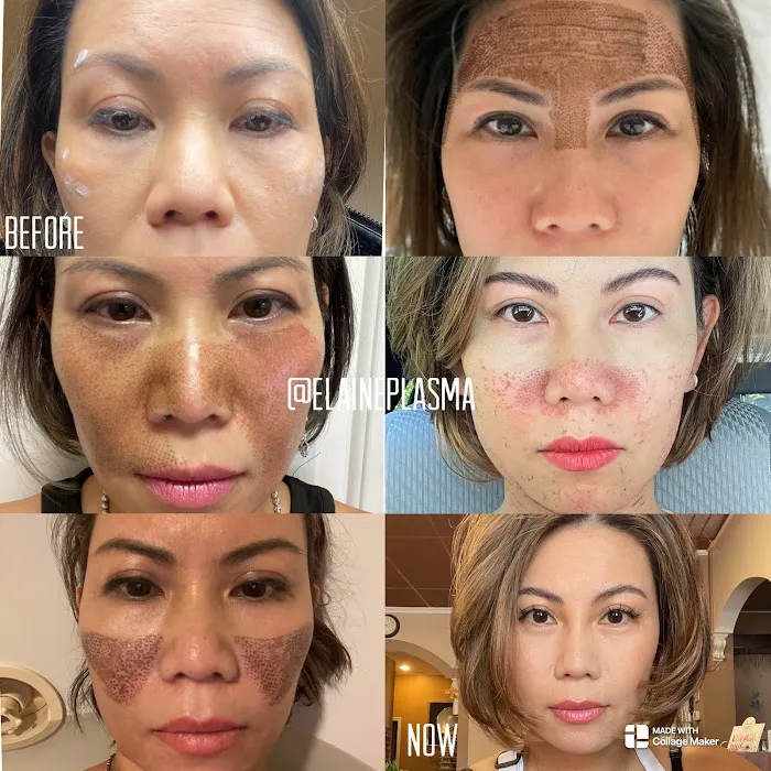 Elaine Plasma Fibroblast Picture 2