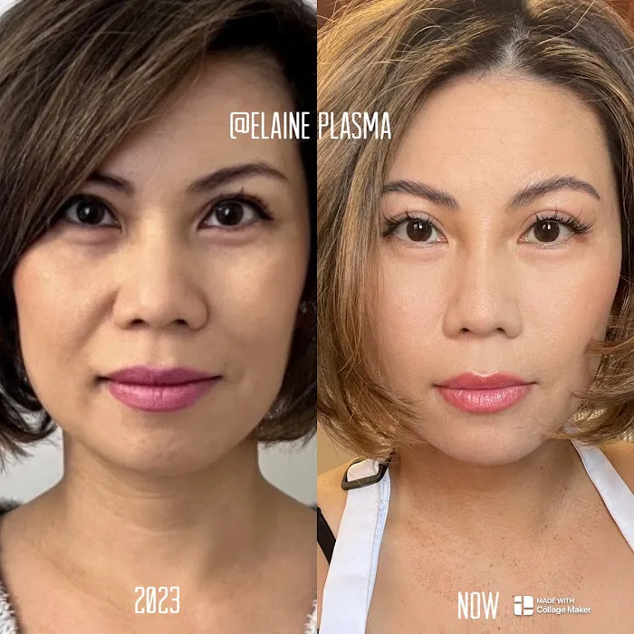 Elaine Plasma Fibroblast Picture 3