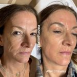 Elaine Plasma Fibroblast