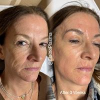 Elaine Plasma Fibroblast ico