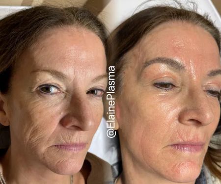 Elaine Plasma Fibroblast