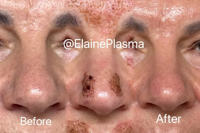 Elaine Plasma Fibroblast Picture 4