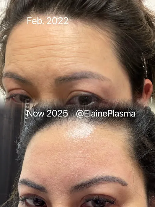 Elaine Plasma Fibroblast Picture 8