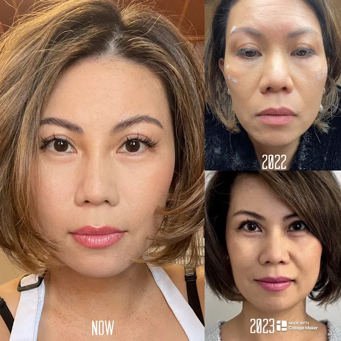 Elaine Plasma Fibroblast Picture 5