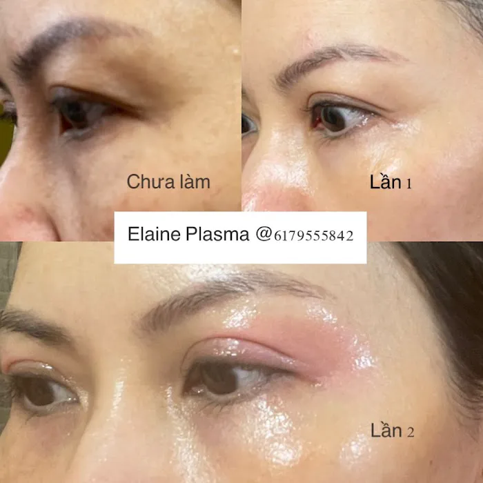 Elaine Plasma Fibroblast Picture 7