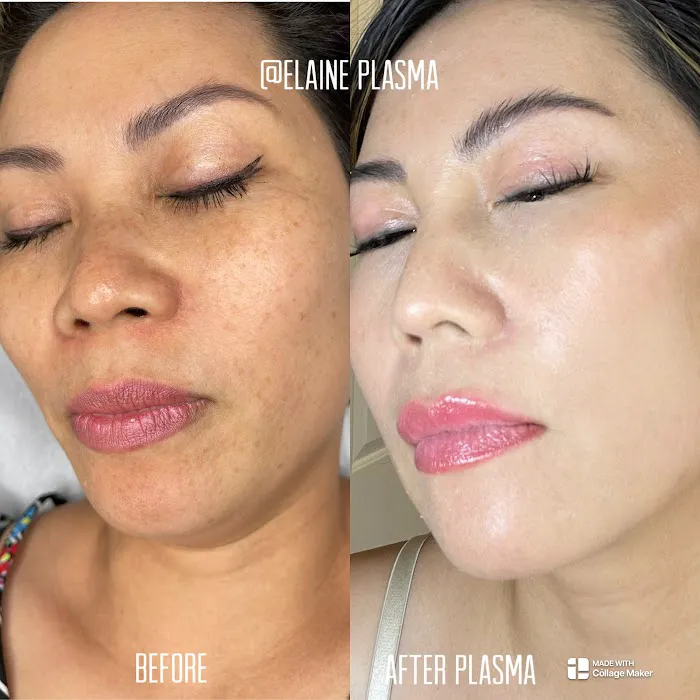 Elaine Plasma Fibroblast Picture 6