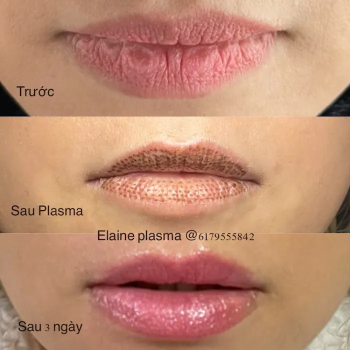 Elaine Plasma Fibroblast Picture 9