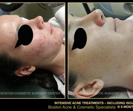 Boston Acne Specialists