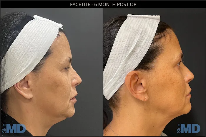 SkinMD Peabody Picture 8