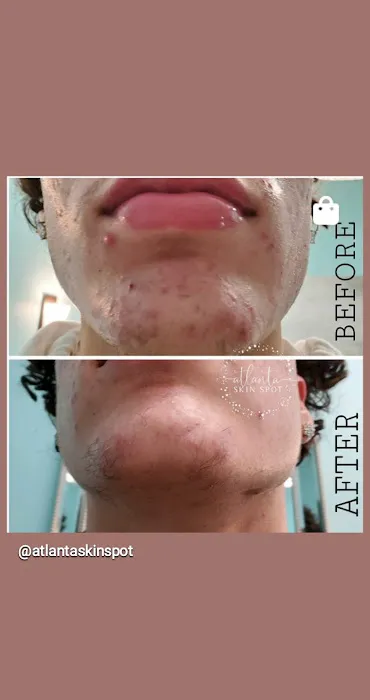 Atlanta Skin Spot Picture 10