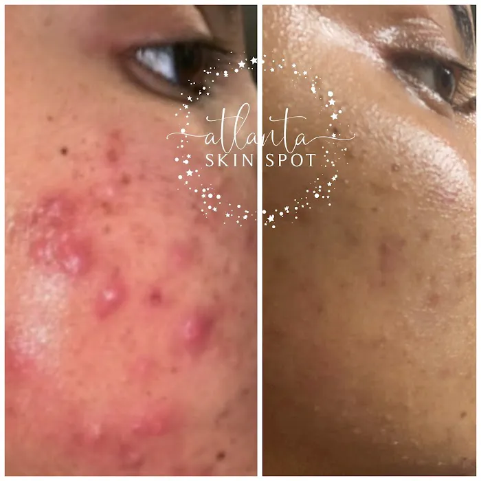 Atlanta Skin Spot Picture 9