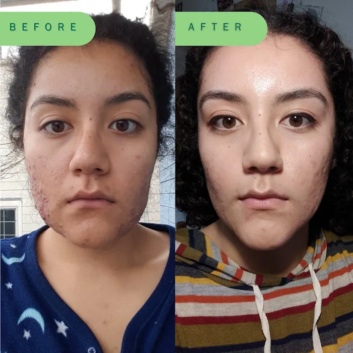 Skin Nutritious • holistic acne clinic Picture 8