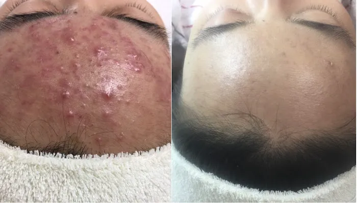 Acne Treatment SF Picture 4