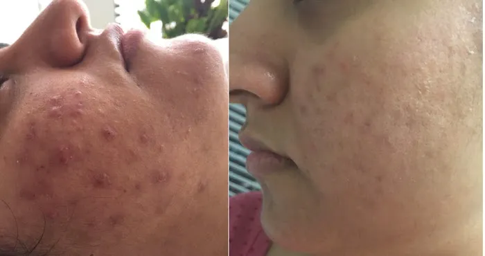 Acne Treatment SF Picture 6