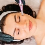 SF Microneedling