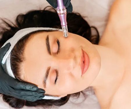 SF Microneedling