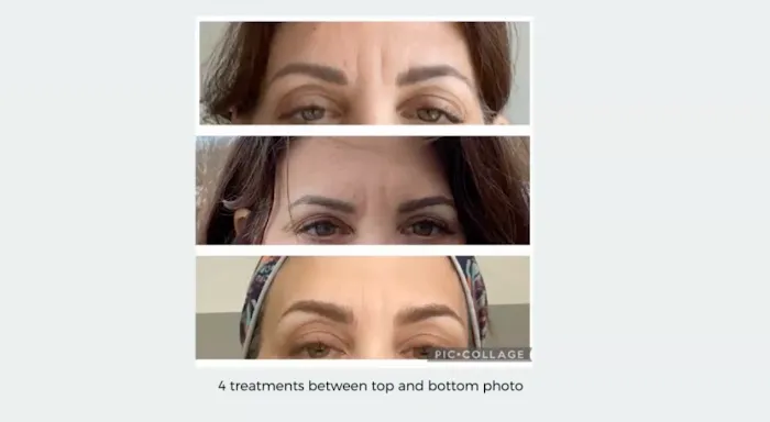 SF Microneedling Picture 4