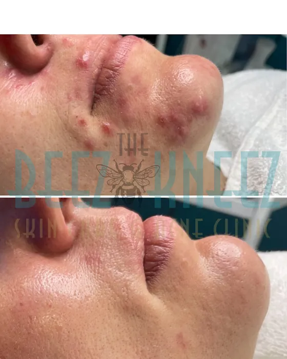 The Beez Kneez Skin Care & Acne Clinic Picture 3