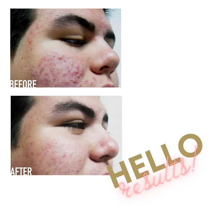 The Beez Kneez Skin Care & Acne Clinic Picture 10