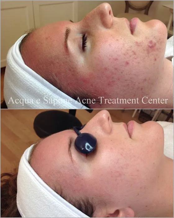 AES Acne Clinic Picture 5
