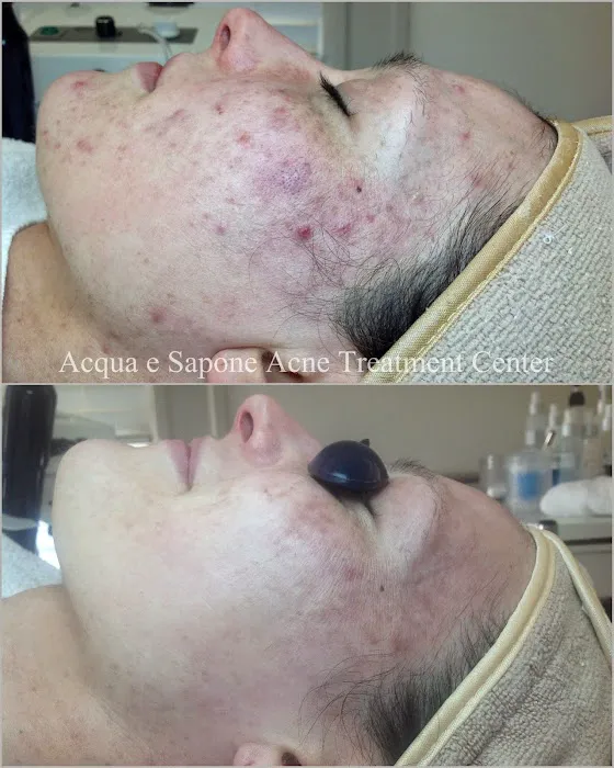 AES Acne Clinic Picture 4