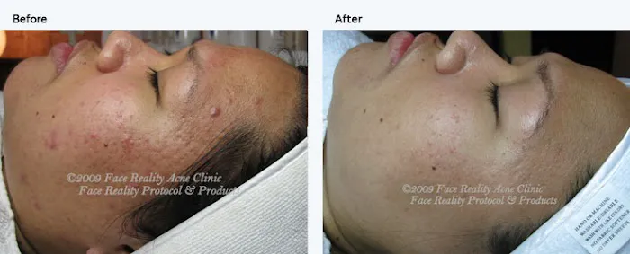 La Petite Rose skincare & acne solution Picture 1