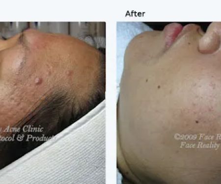 La Petite Rose skincare & acne solution