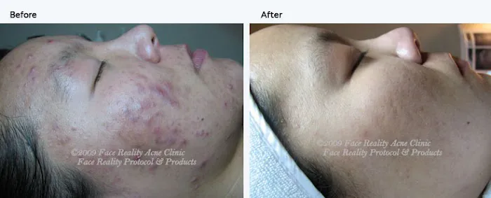 La Petite Rose skincare & acne solution Picture 5