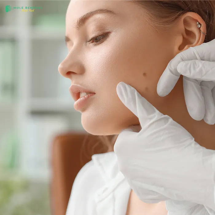 Mole Removal Menlo Park Picture 3