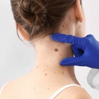Mole Removal Menlo Park ico