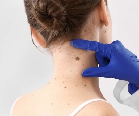 Mole Removal Menlo Park