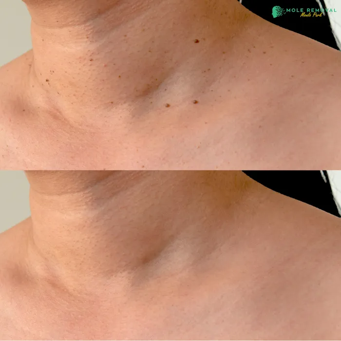 Mole Removal Menlo Park Picture 4