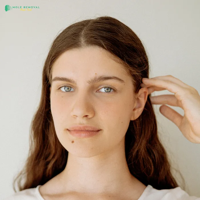 Mole Removal Menlo Park Picture 6