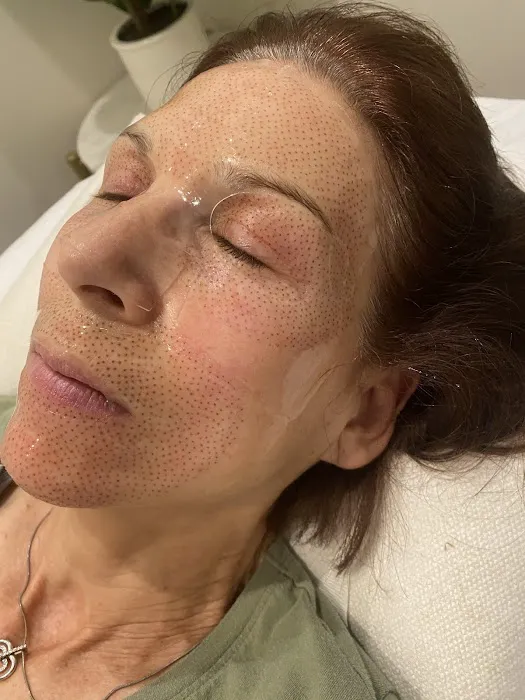 Eternal Youth Plasma Skin Tightening Therapy Picture 4