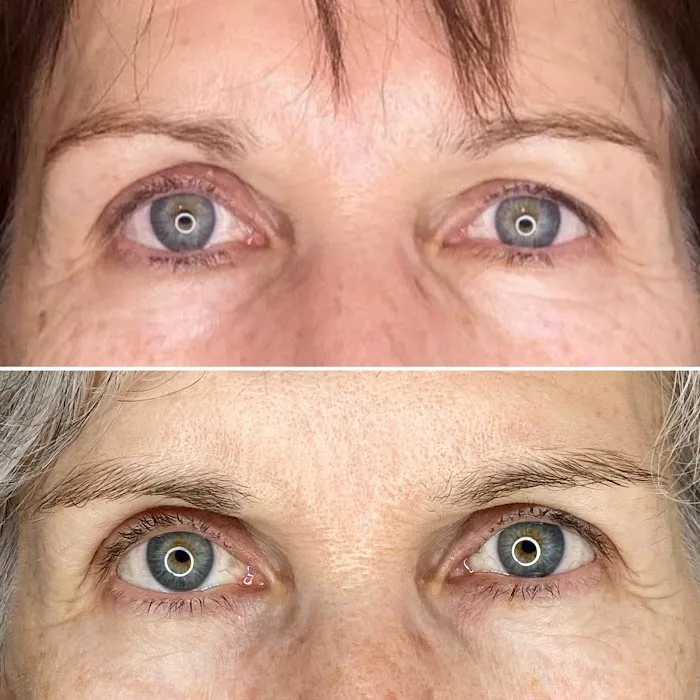 Eternal Youth Plasma Skin Tightening Therapy Picture 5