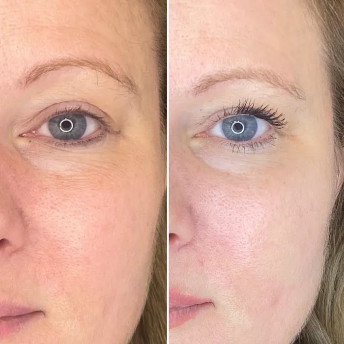 Eternal Youth Plasma Skin Tightening Therapy Picture 6