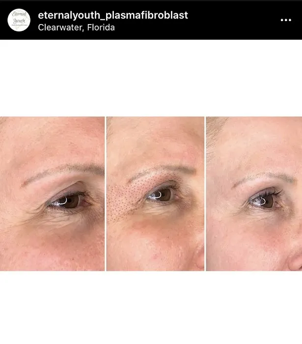 Eternal Youth Plasma Skin Tightening Therapy Picture 7