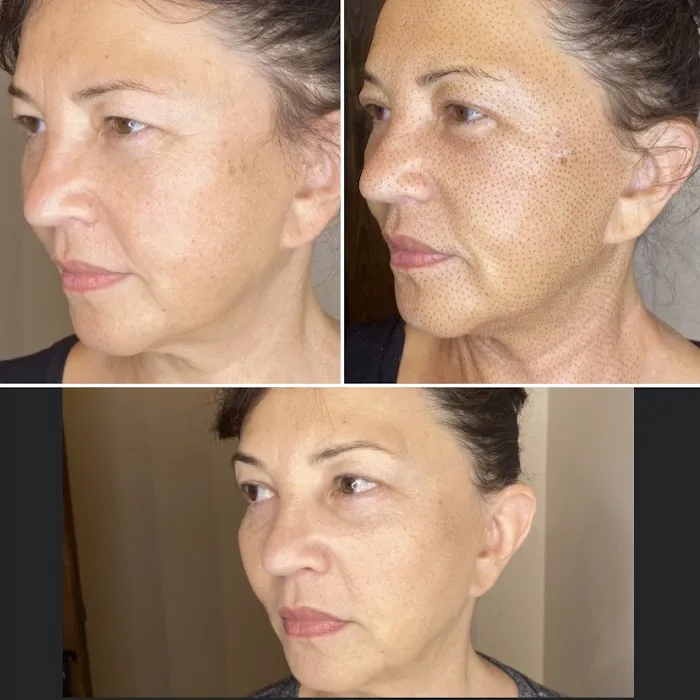 Eternal Youth Plasma Skin Tightening Therapy Picture 10